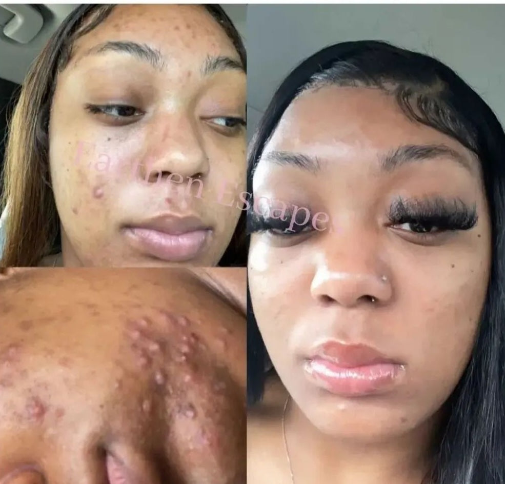 Before and after photo of dark spots and hyperpigmentation