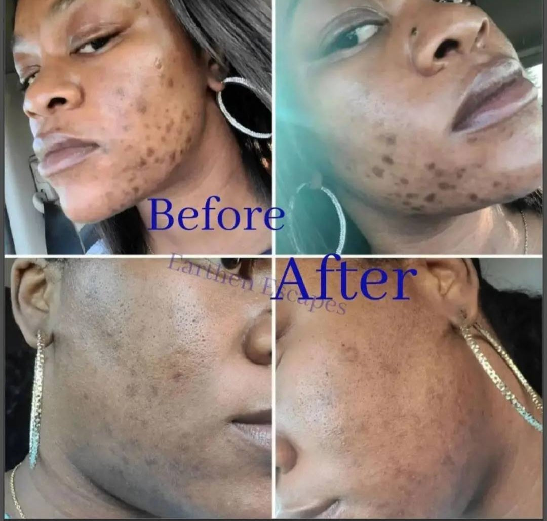 Picture of before and after of dark spots