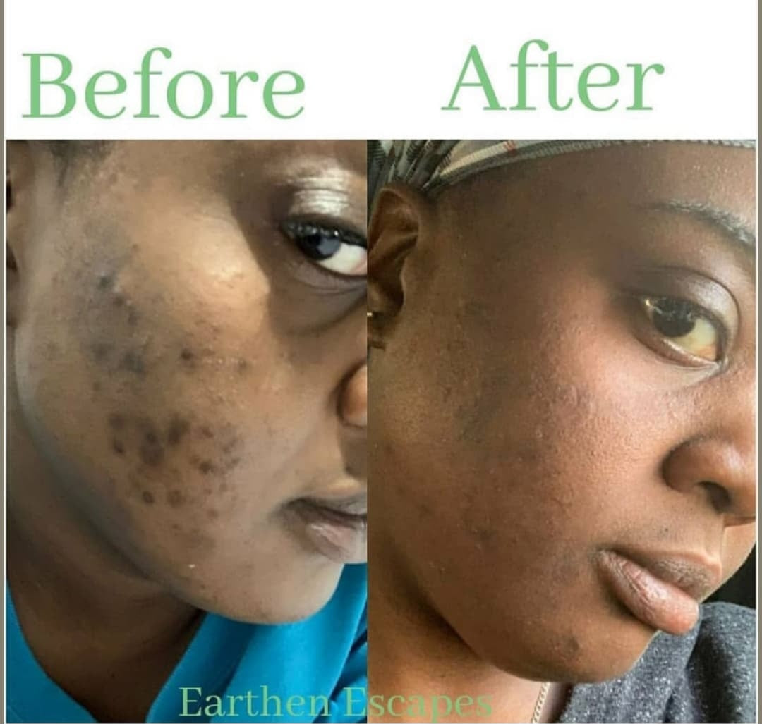 Picture of before and after of dark spots