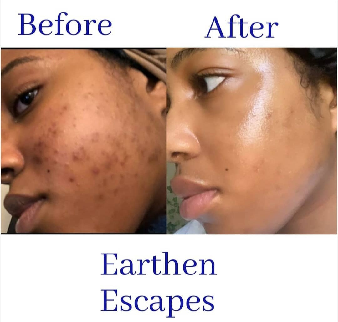 Picture of before and after of dark spots