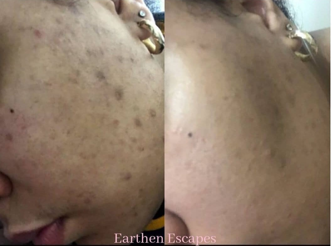 Picture of before and after of dark spots