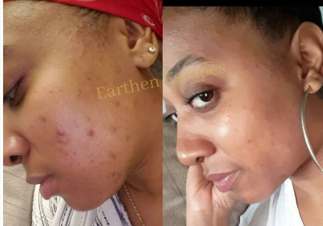 Picture of before and after of dark spots