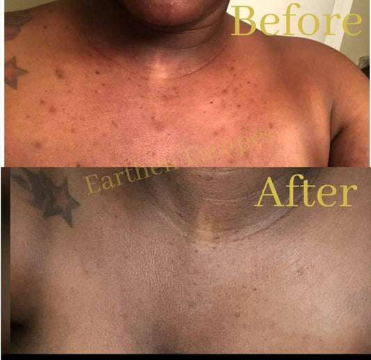 Picture of before and after of dark spots