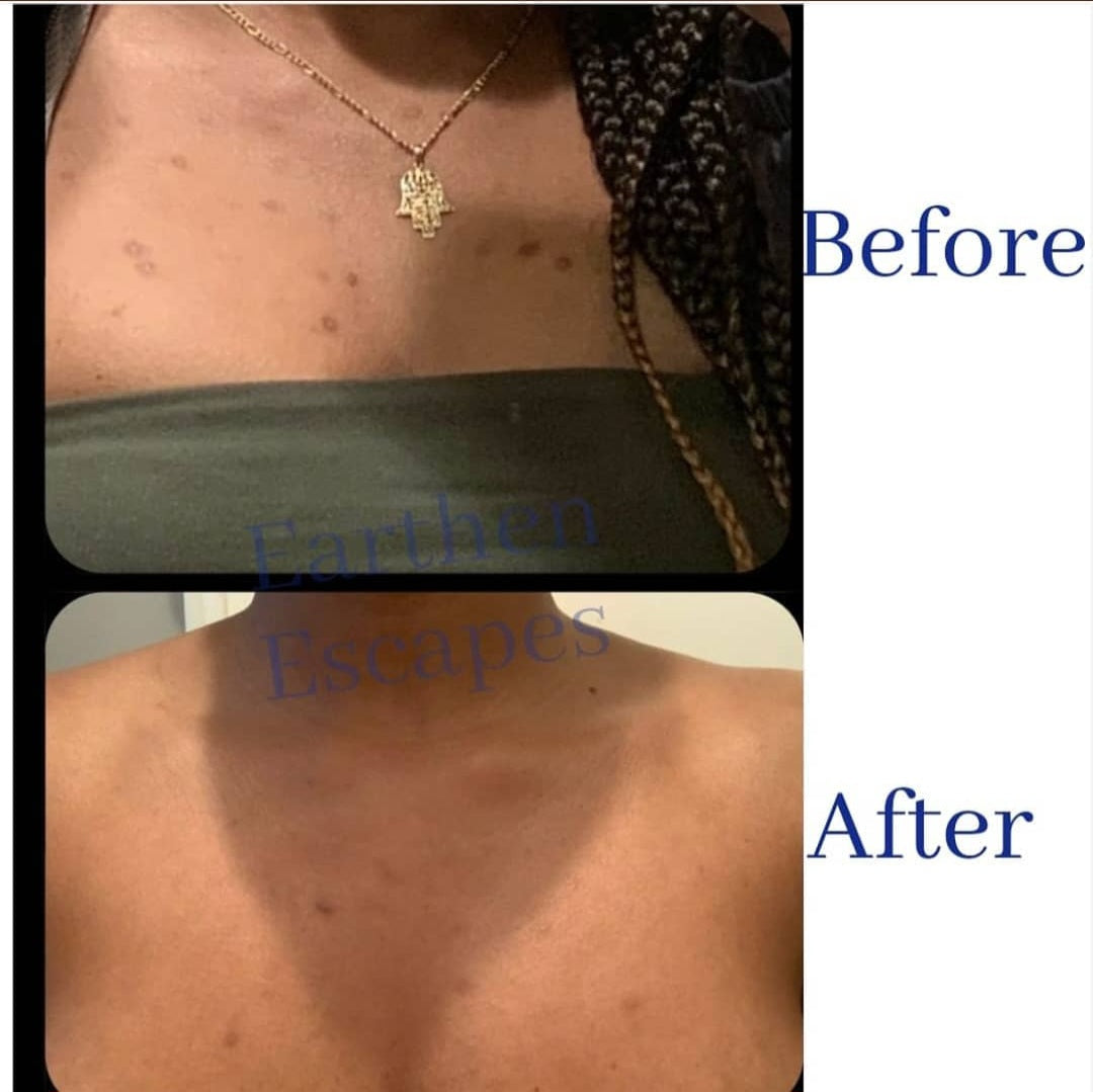 Picture of before and after of dark spots