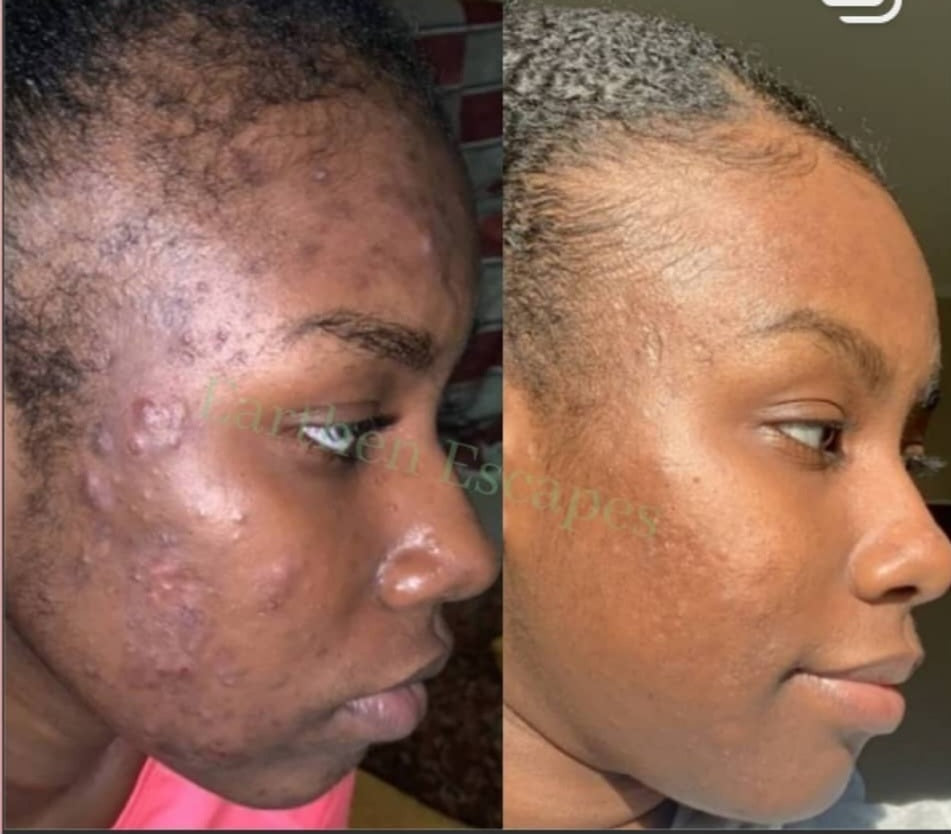 Before and after photo of dark spots and hyperpigmentation and acne