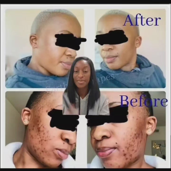 Picture of before and after of dark spots