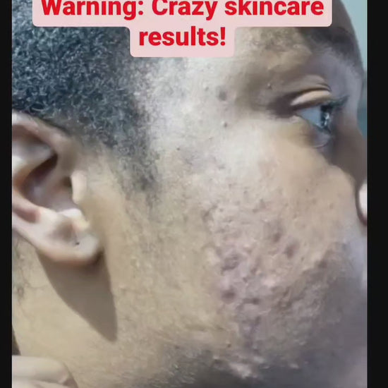 Video results of before and after using the Dark Spot Corrector and Green Tea Facial Soap