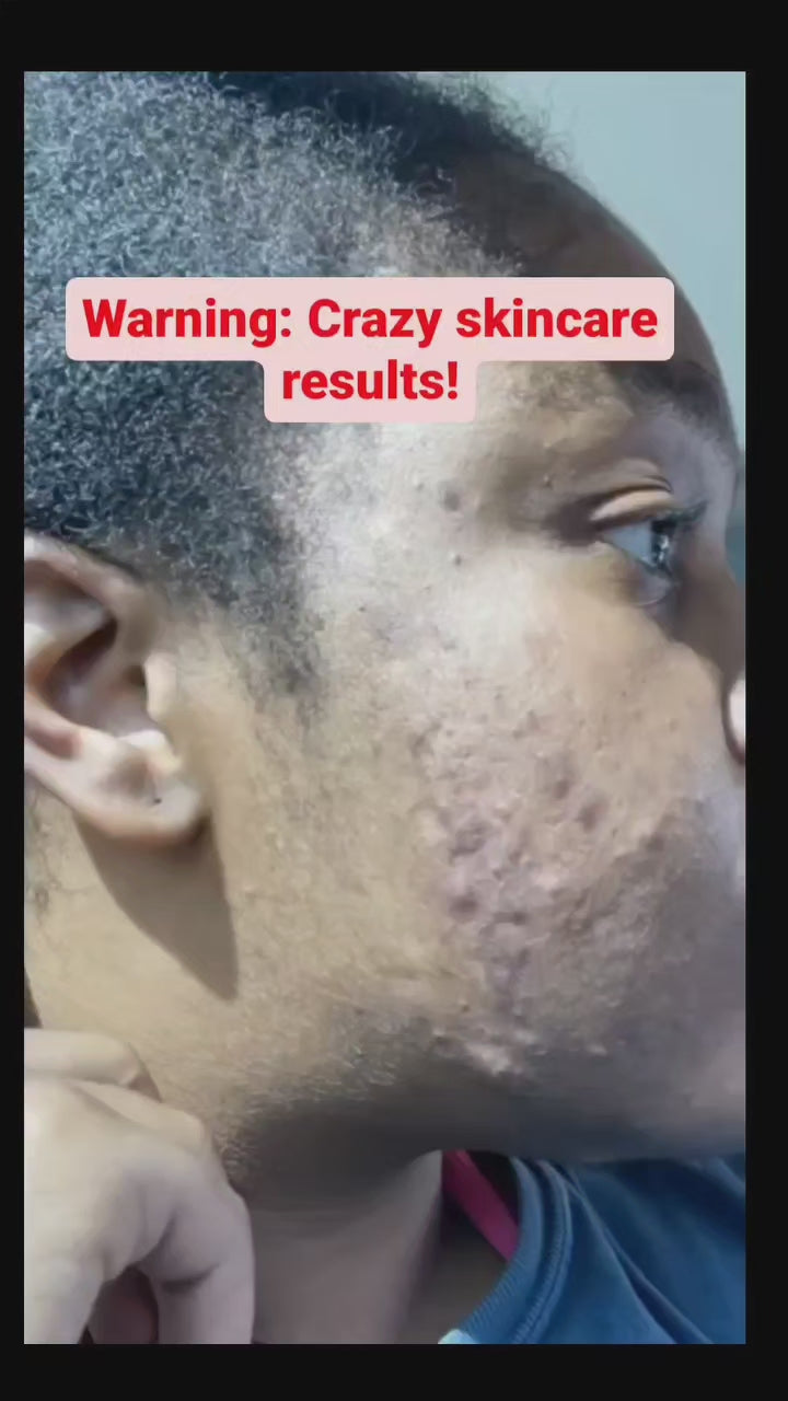 Video results of before and after using the Dark Spot Corrector and Green Tea Facial Soap