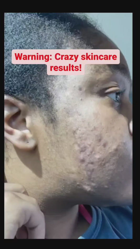 Video results of before and after using the Dark Spot Corrector and Green Tea Facial Soap