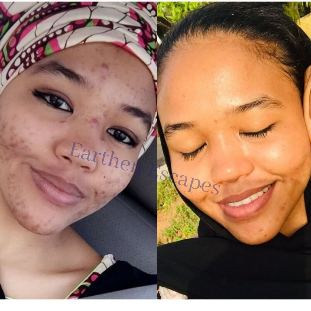 Before and after photo of dark spots and hyperpigmentation and acne