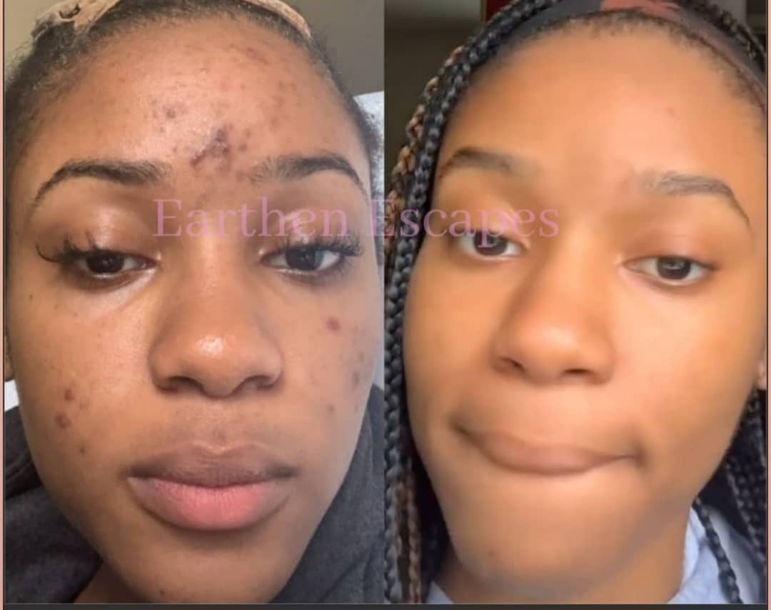Before and after photo of dark spots and hyperpigmentation