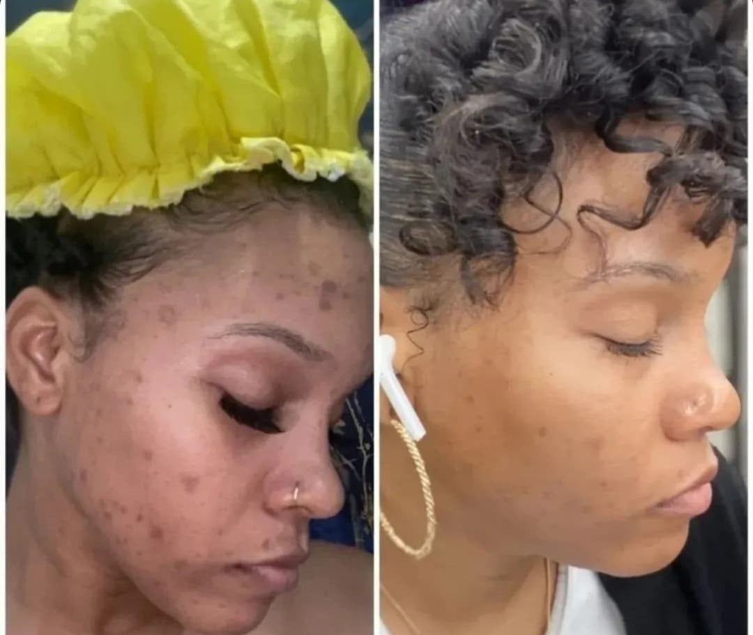 Picture of before and after of dark spots