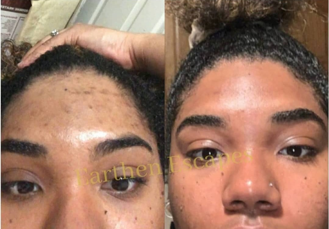 Picture of before and after of dark spots