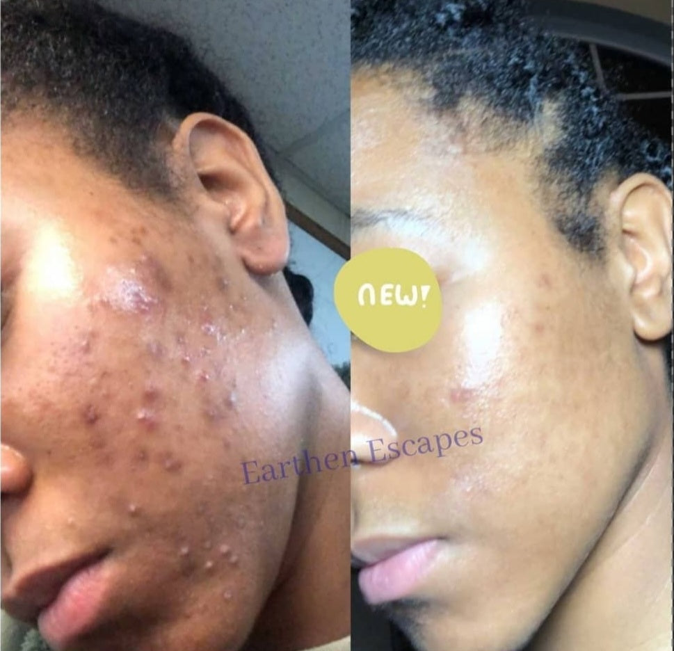 Picture of before and after of dark spots