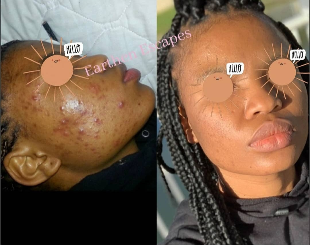 Picture of before and after of dark spots and acne