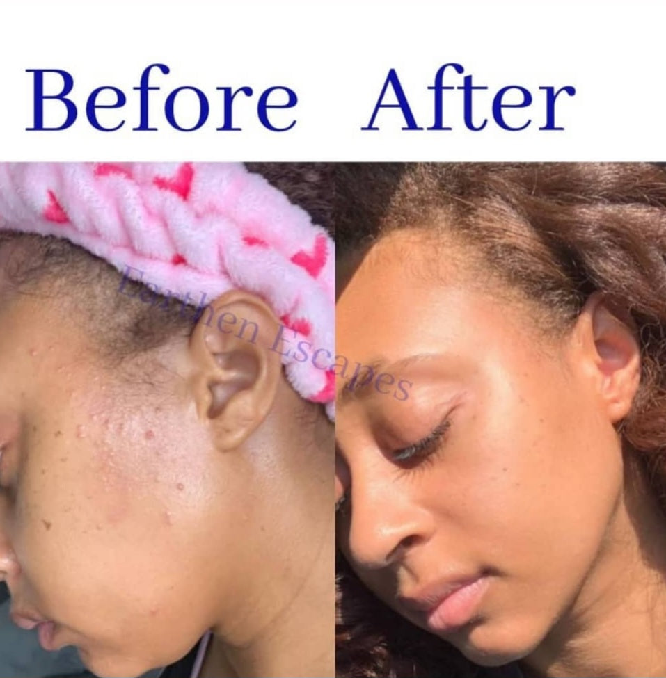 Picture of before and after of dark spots and acne
